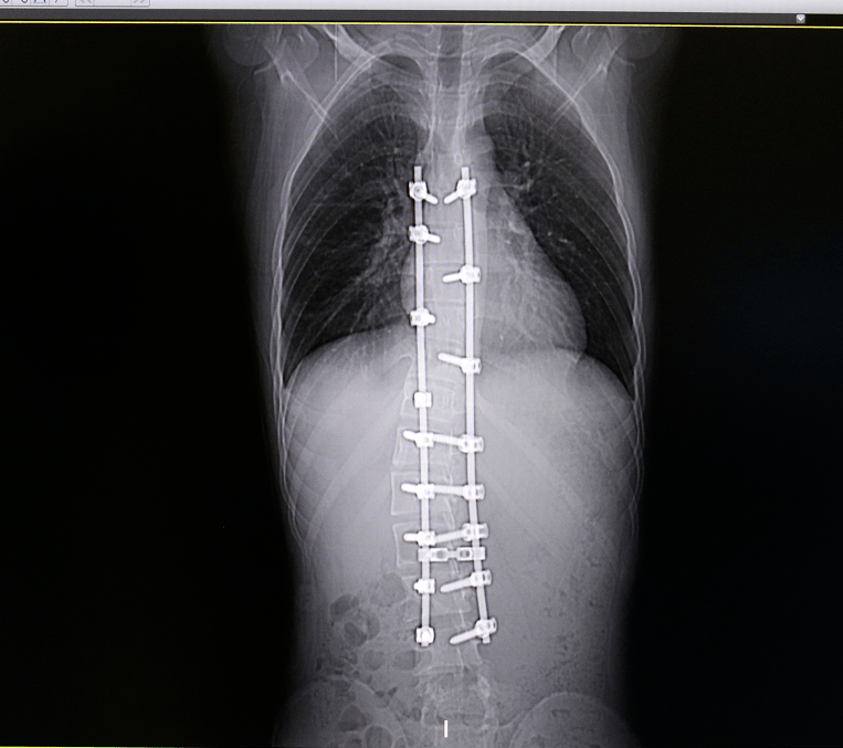 父母带着小龙到贵州华夏骨科医院检查,确诊小龙脊柱向右侧弯70余度