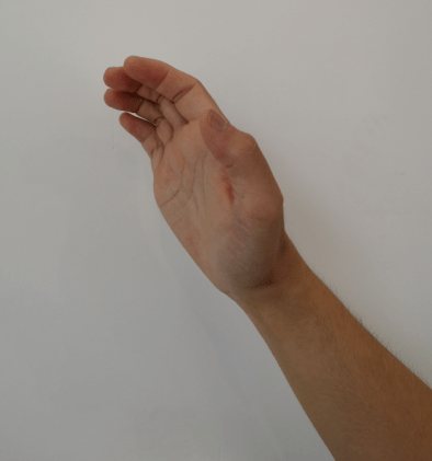 正中神经损伤"爪形手"(尺神经损伤)垂腕(桡神经损伤)1,肢体畸形:当