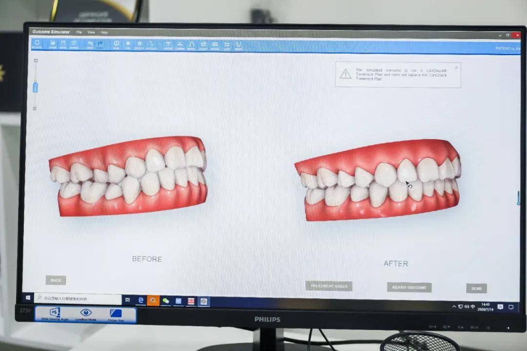 口腔|变美秘密！明星同款牙齿隐形矫正，隐适美暑期半价福利！