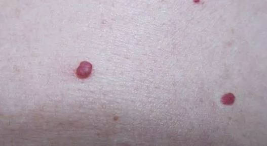 血痣是最常见的小红点的症状,大多是因为肤表或黏膜局部毛细血管持续