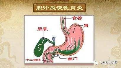 反流性胃炎:6种中医辩证常用药方案