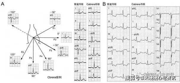 cabrera心电图导联排列方式