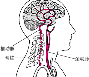 【颈椎】让人"头疼"颈椎病 椎动脉型颈椎病