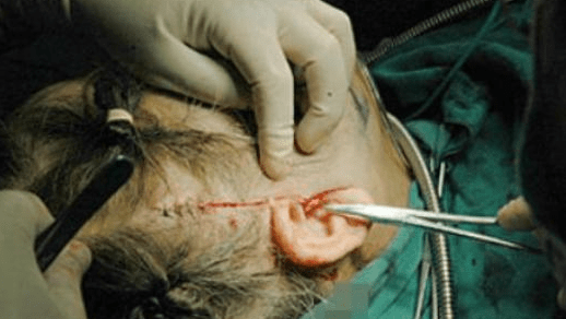 同时将面部深部筋膜层也拉紧,切口多选在发际内,耳旁或耳后隐蔽处,术