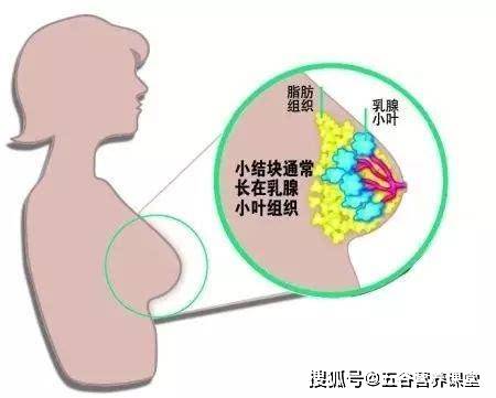 女人若出现乳腺结节,3物再馋也要拉入黑名单