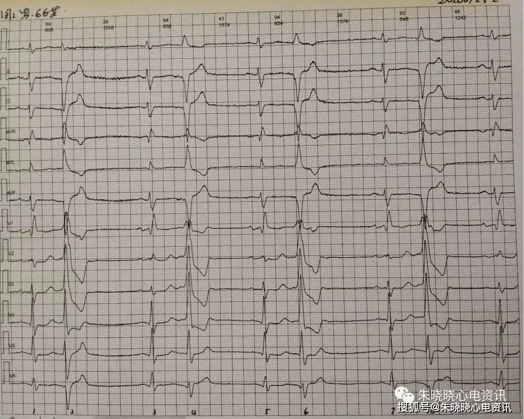 卢老师看心电图-- 交界性逸搏 多源室性早搏二联律 2020-7-29