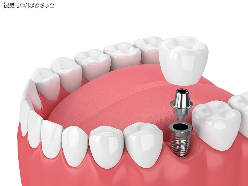 种植牙?深圳河山口腔科普