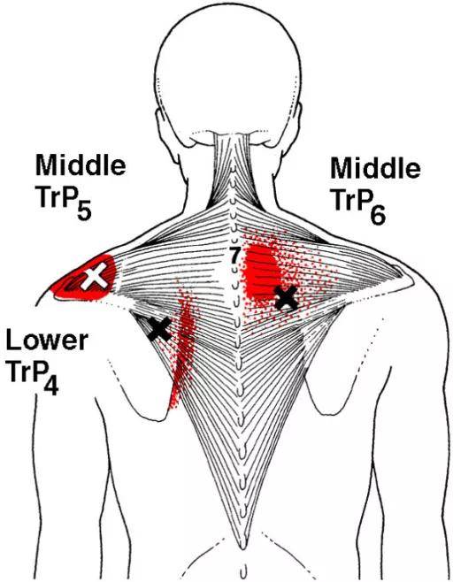 主要表现的症状为疼痛沿着肩胛骨内侧下缘,且近脊柱侧疼痛减轻
