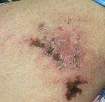 患者|浑身多系统被“攻击”，竟是皮肌炎“作祟”