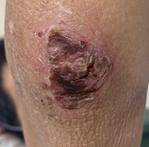 患者|浑身多系统被“攻击”，竟是皮肌炎“作祟”