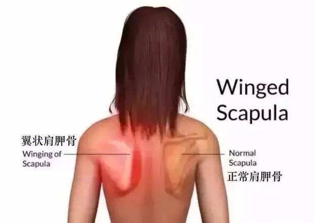 翼状肩胛会使你无法平衡周围肌肉的张力,导致肩胛骨周围产生疼痛感.