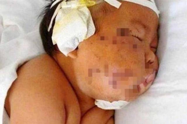 原创还记得4年前被妈妈拿剪刀划成“花脸猫”的男婴吗？现在成这样了