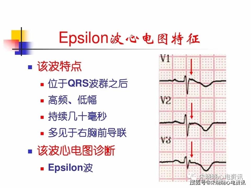 fontaine导联与epsilon波