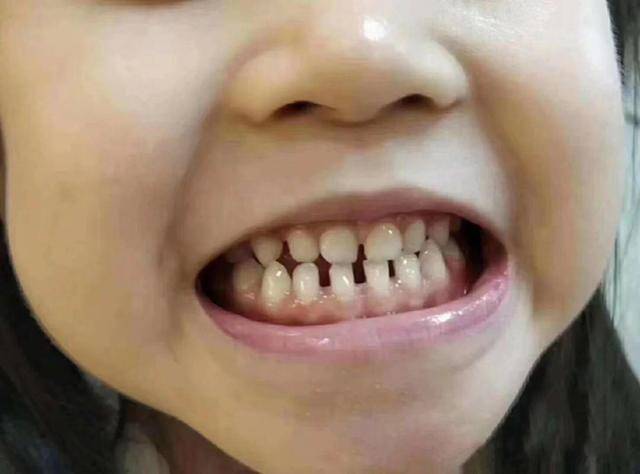 恒牙|网友说，太丑太吓人整牙医生说：这才是我们最想看到的乳牙