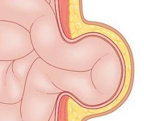 原创"小鼓包"或成大问题 专家:手术治疗疝气可从半岁开始