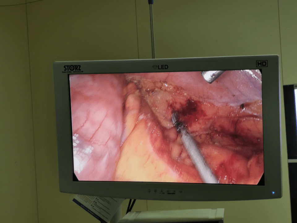 腹腔镜|太原中心医院胃肠外科汾东病区完成全腹腔镜下结肠癌肝转移同期术