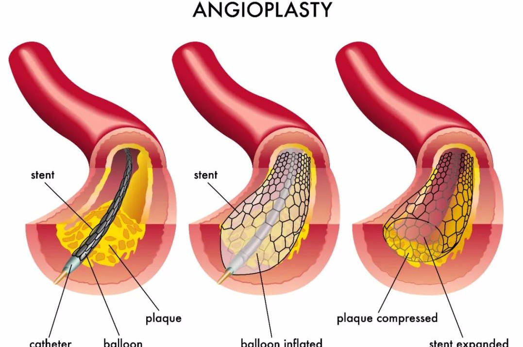 心脏|百年协和讲堂 | 如何区分心绞痛和心梗？专家教你“找不同”