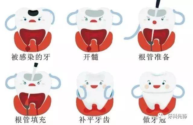 根管治疗的收费标准原来是这样?