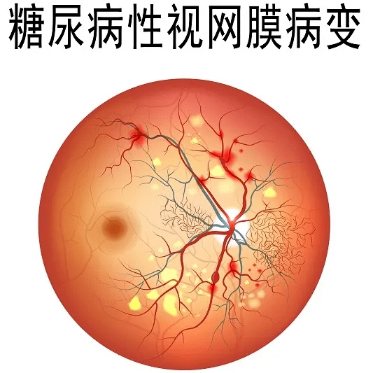 糖尿病患者长期的血糖偏高,导致血管内皮细胞受损,引起的眼睛视网膜