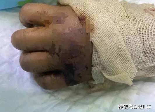 伤口|整个手变黑险丧命!带娃外出,千万当心这东西…男童摸了“花蘑菇”