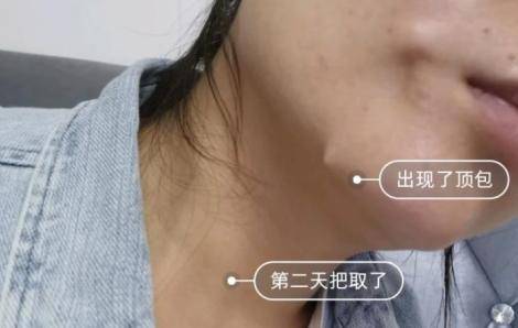 蛋白线提升线头冒出来,线雕失败毁容图片你害怕吗