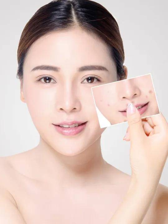 怎么做才能减少痘痘 ce4a0c6bc61b48bb88e4ac776eb20793.jpeg