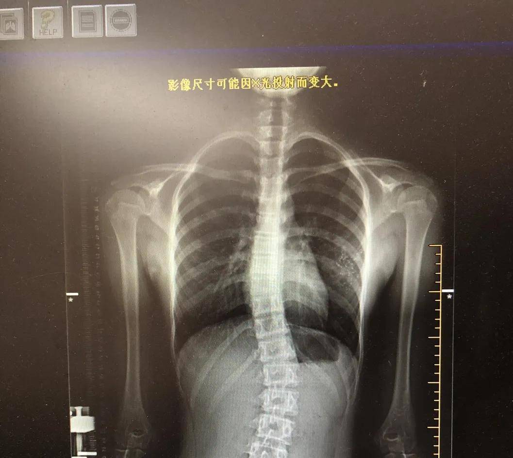 升学体检发现脊柱s型了看玉环市中医院如何康复矫正变弯的脊柱