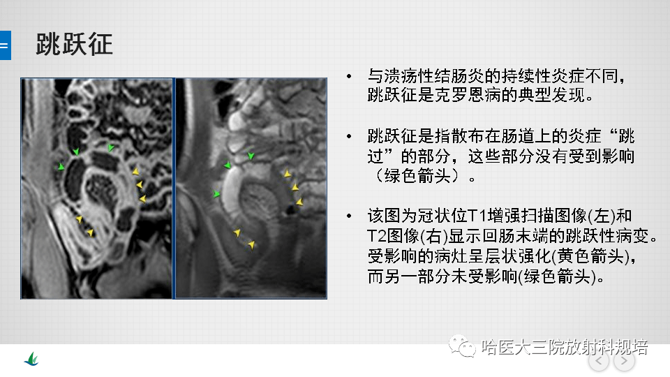 克罗恩病mri评估