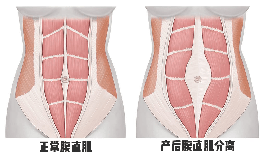 仰卧侧卷腹训练部位腹内斜肌_使劲划开肚脐腹_测腹直肌分离是测肚脐的位置吗