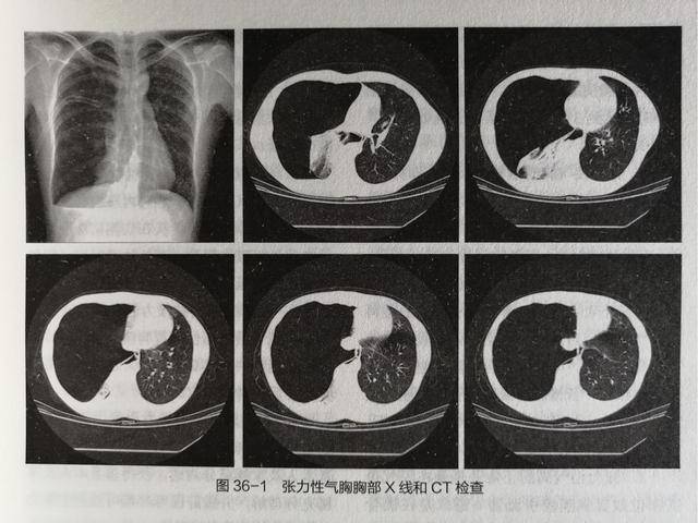 原创围麻醉期突发张力性气胸的原因分析及应对策略