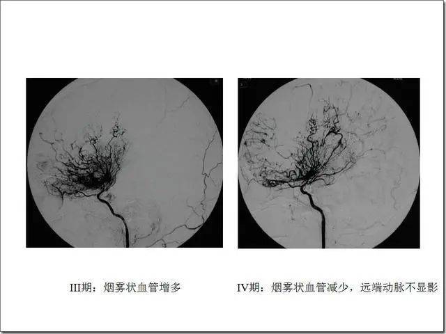 烟雾病跟抽烟无关它是一种可怕的脑血管病