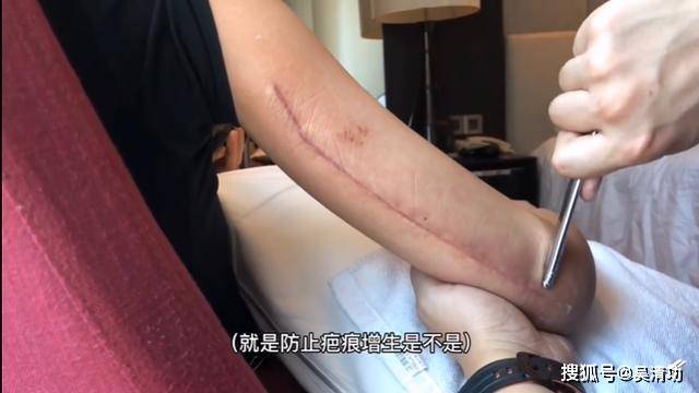 人红是非多：万茜被质疑“假骨折”，效仿鹿晗