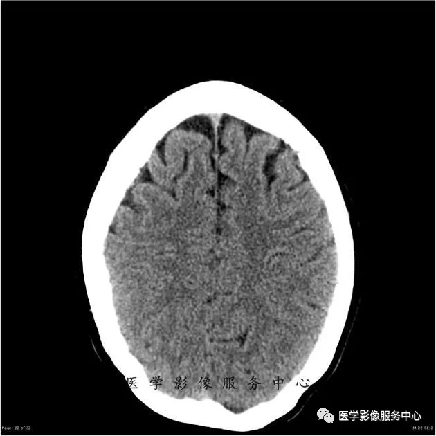 这例头颅ct片中,你能找到病变吗?#医学影像病例