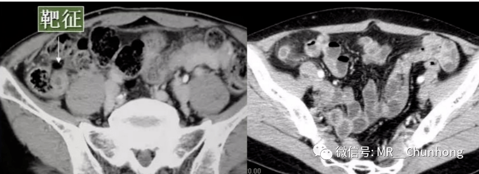 【基础诊断】一文读懂急性阑尾炎的ct诊断_解剖