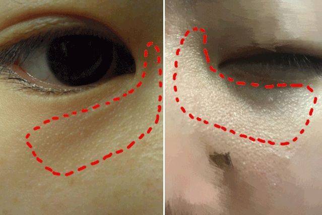 鼻梁两侧和眼周有很多小颗粒怎么办_皮肤