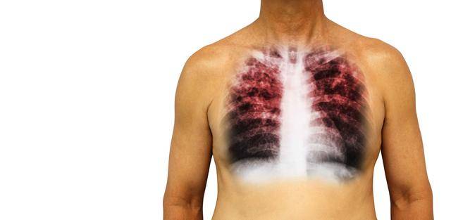 原创每年近80万人确诊患肺癌！除了抽烟，4件事太伤肺，越早改掉越好