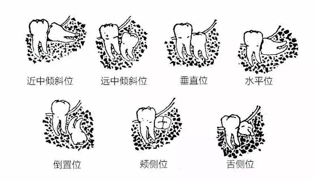 还有智齿和下颌支及第二磨牙的关系,分为了三类