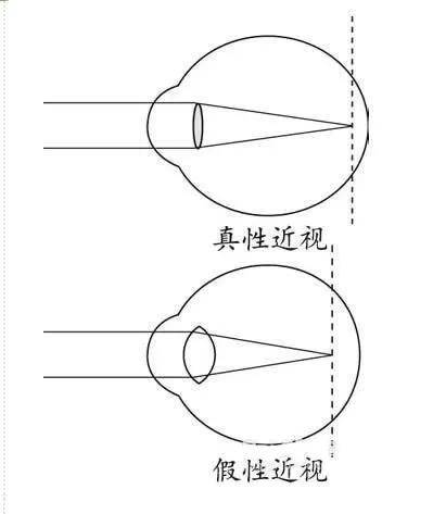 青少年近视怎么控制度数不增加 2ef1e011d24c4ce48c6592ae7fa861ea.jpeg
