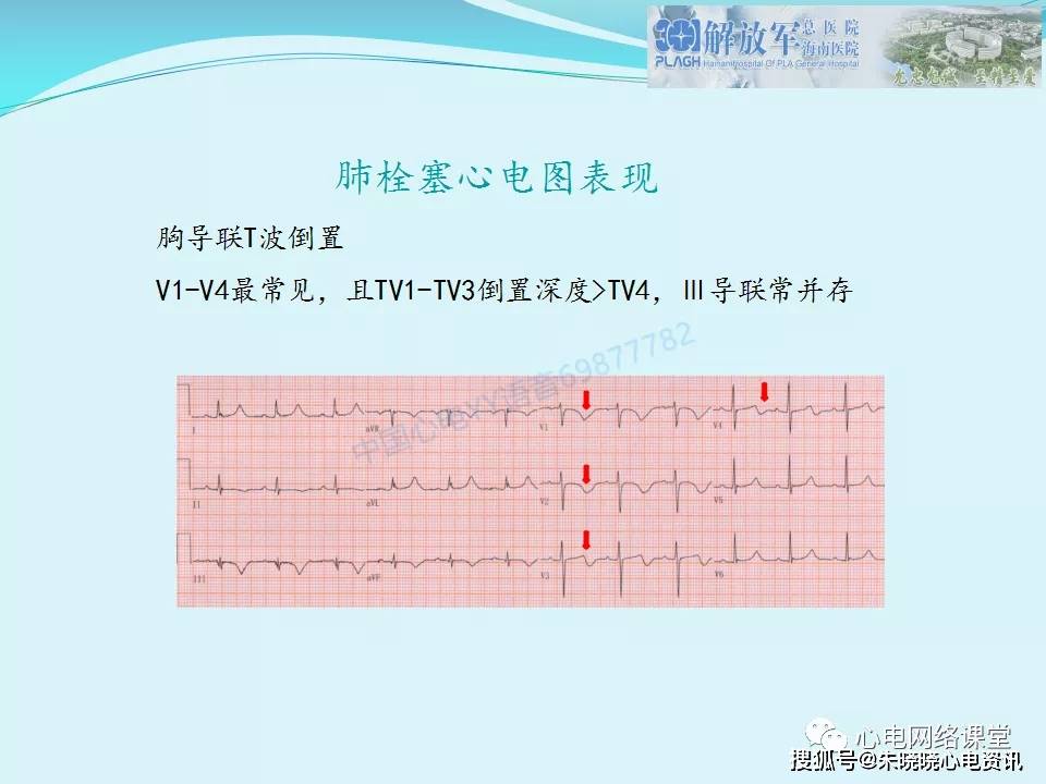 肺栓塞心电图表现及鉴别诊断