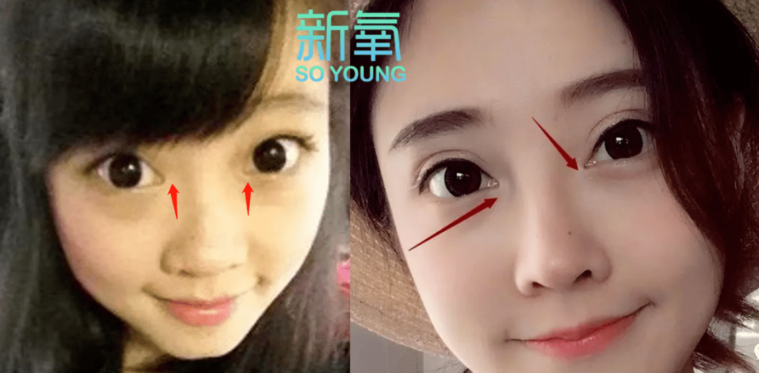 do|冯提莫这是后遗症出来了还是do了两次？搞成猪鼻子了…