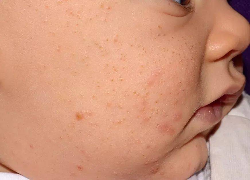 还把宝宝脸上的「痘痘」叫湿疹?其实那是新生儿痤疮