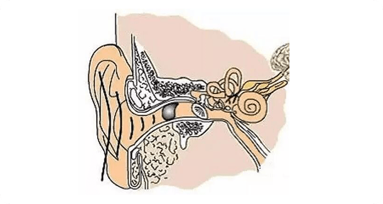 看看容易被误诊的外耳道胆脂瘤!