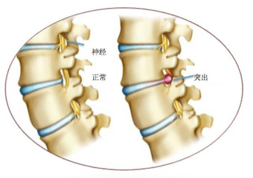 同样是腰椎间盘突出,为什么有人安然无恙,有人痛不欲生?