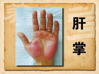 手脚|体内有癌,手脚先知,当手脚出现这些变化,说明肝已经病得不轻