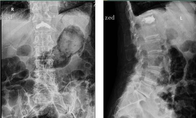 骨质疏松多久见效果 0bf0359fa3694e25aa184dae6fb96966.jpeg