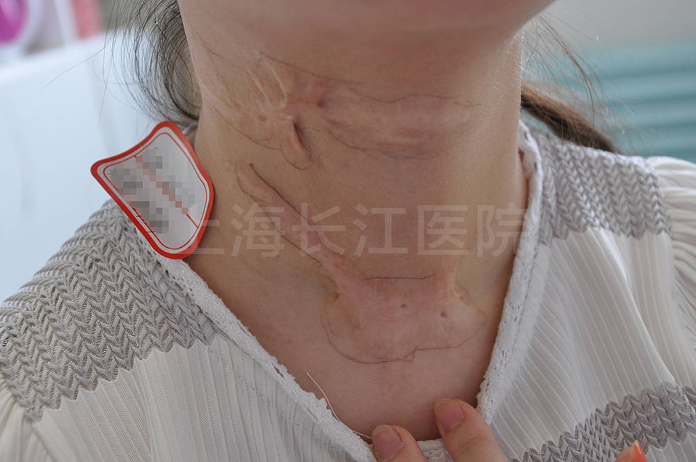 上海长江疤痕医院肖萍科普:增生性疤痕的分期与分度