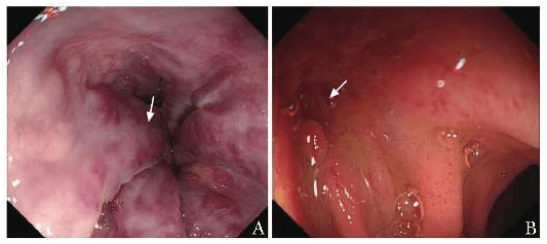 门静脉|腹痛,十二指肠溃疡,门静脉高压:非一般性“胰腺占位”