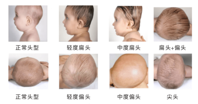 婴儿头左右不对称 a8892018fb6043b49dee9205a41aaa3c.png