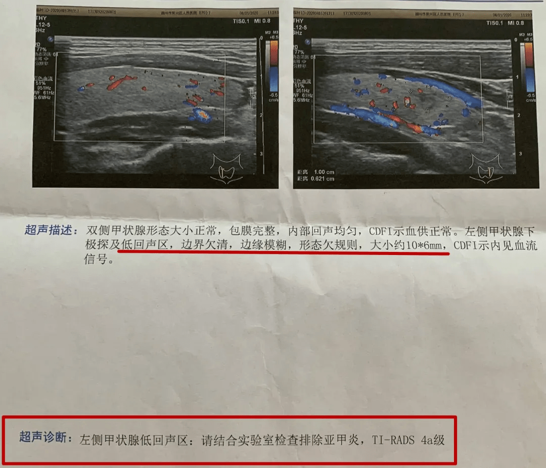 病人拍胸椎ct扫到甲状腺结节,复查就是4a类,下一步该?