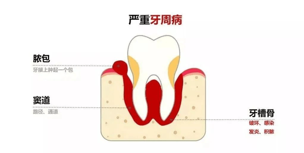 大连齿医生口腔科普 你牙龈上长过脓包吗,知道是怎么回事吗?